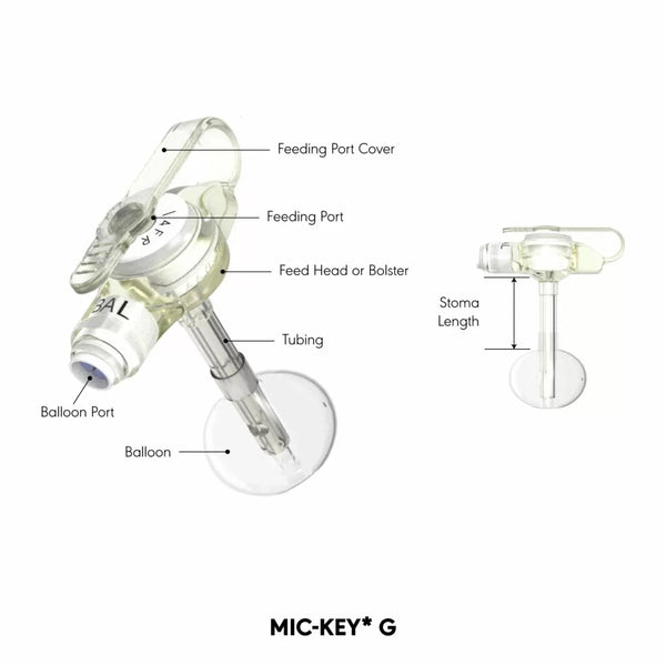 MIC-KEY Gastrostomy Feeding Tube Kit