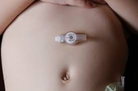 MIC-KEY Gastrostomy Feeding Tube Kit