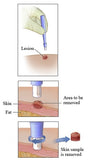 Dermal Punch, Biopsy Punch, Biopsy, Biopsy Dermal Punch, Biopsy Surgical Punch, Dermal Puncture, Surgical Biopsy Punch, Buy Dermal Punch, Buy Skin Punch, Skin Punch, Piercing Punch
