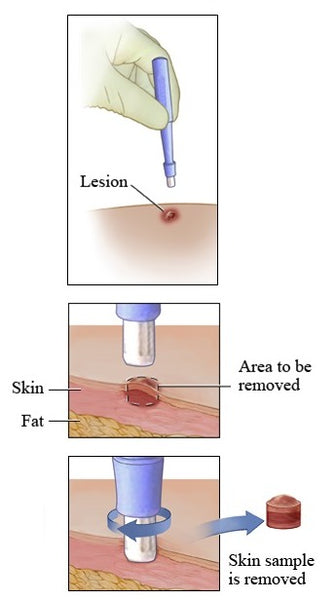 Dermal Punch, Biopsy Punch, Biopsy, Biopsy Dermal Punch, Biopsy Surgical Punch, Dermal Puncture, Surgical Biopsy Punch, Buy Dermal Punch, Buy Skin Punch, Skin Punch, Piercing Punch